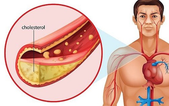 Mỡ máu cao có thể gây biến chứng gì?