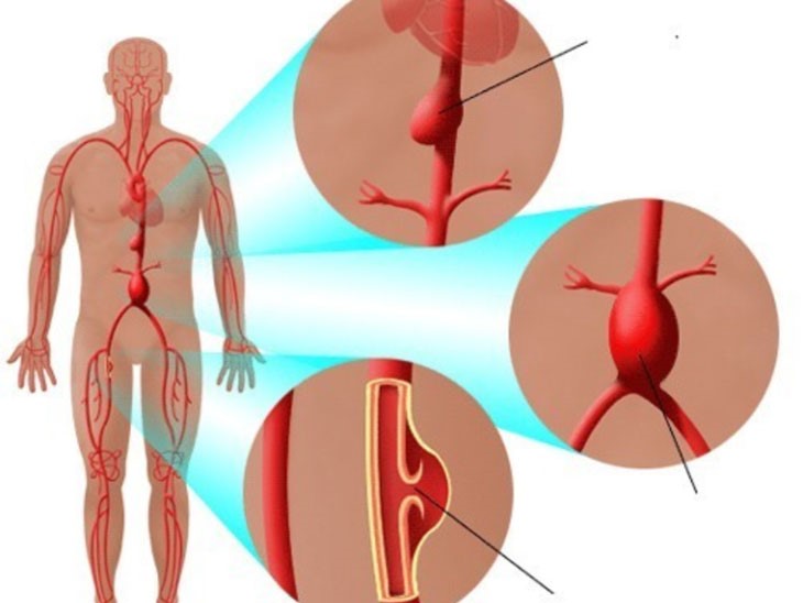 Các phương pháp điều trị phình động mạch chủ- Ảnh 3.