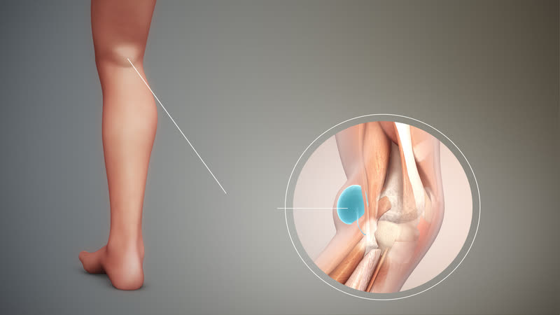 Nhận biết và điều trị nang hoạt dịch vùng khoeo chân