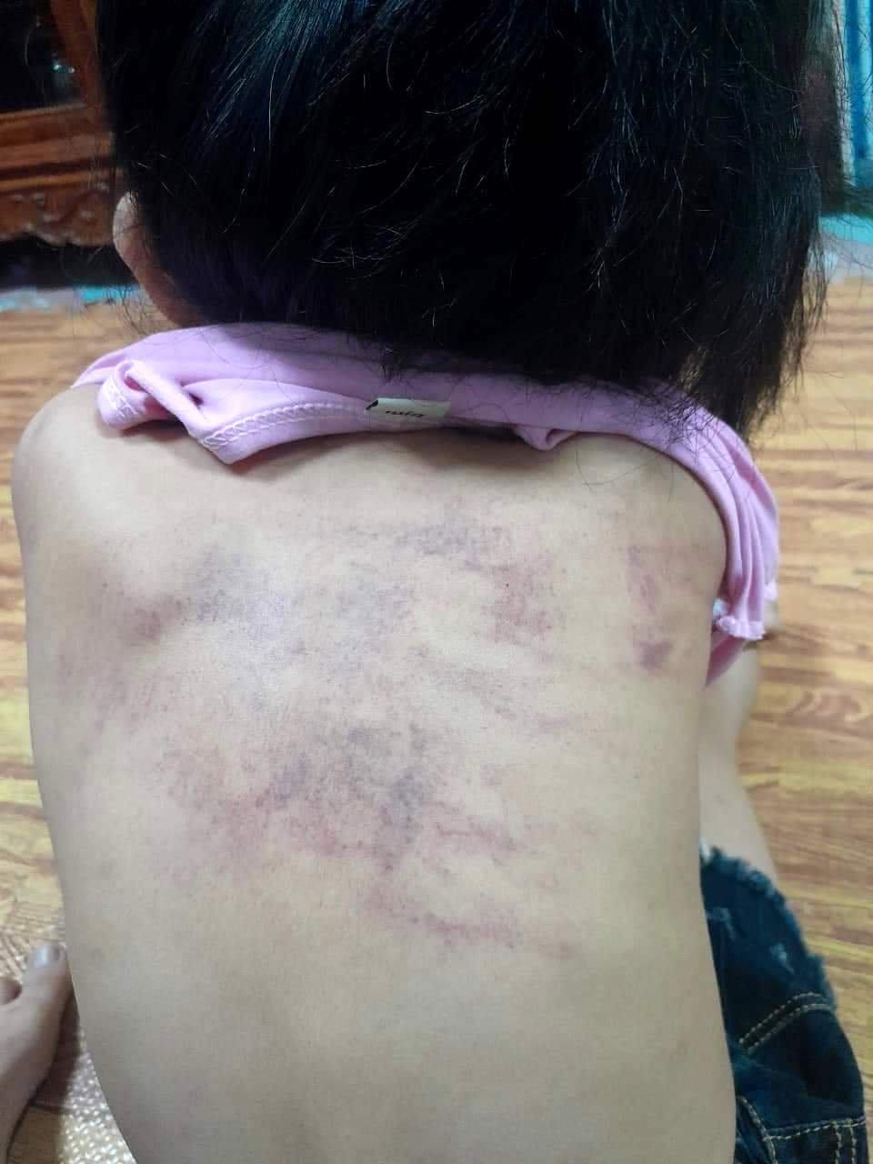 Vụ bé 5 tuổi ở Hải Phòng bầm tím khi đi học: Bị bạn đấm 20 lần vào lưng, gáy- Ảnh 1.
