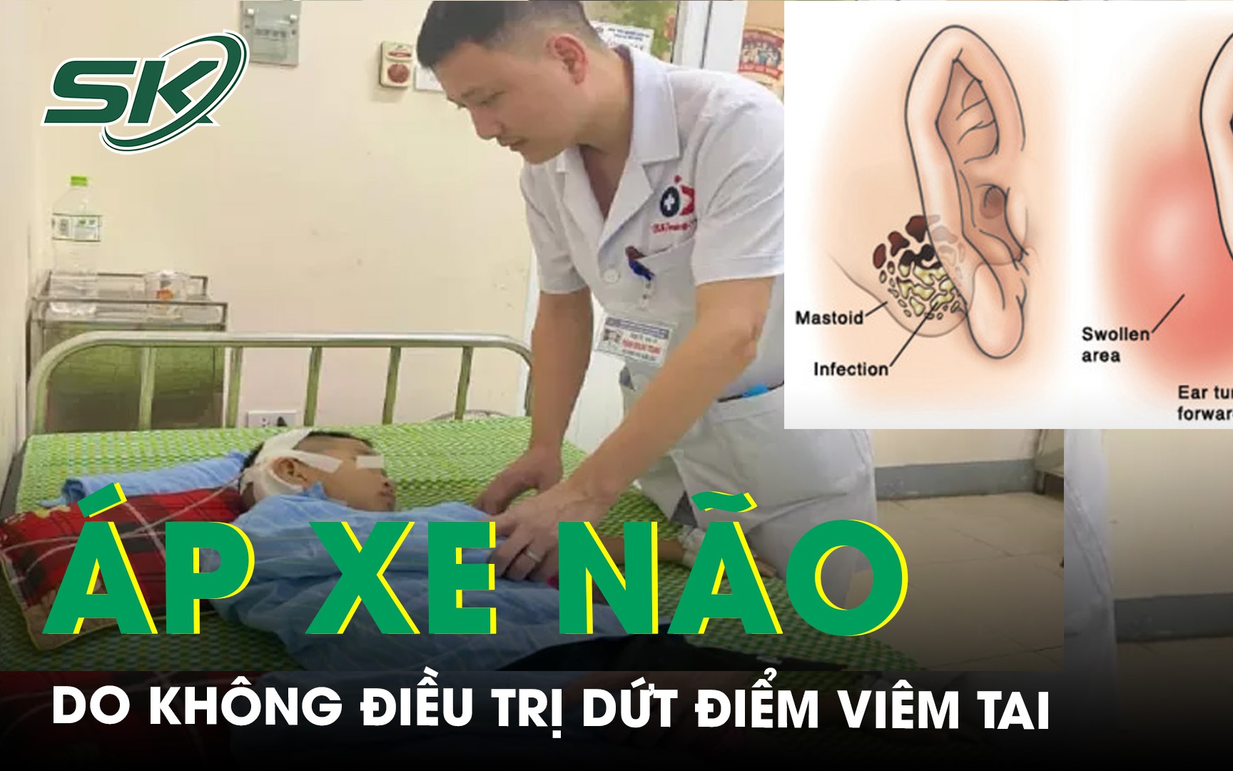 Nguy kịch vì không điều trị dứt điểm viêm tai dẫn tới biến chứng áp xe não