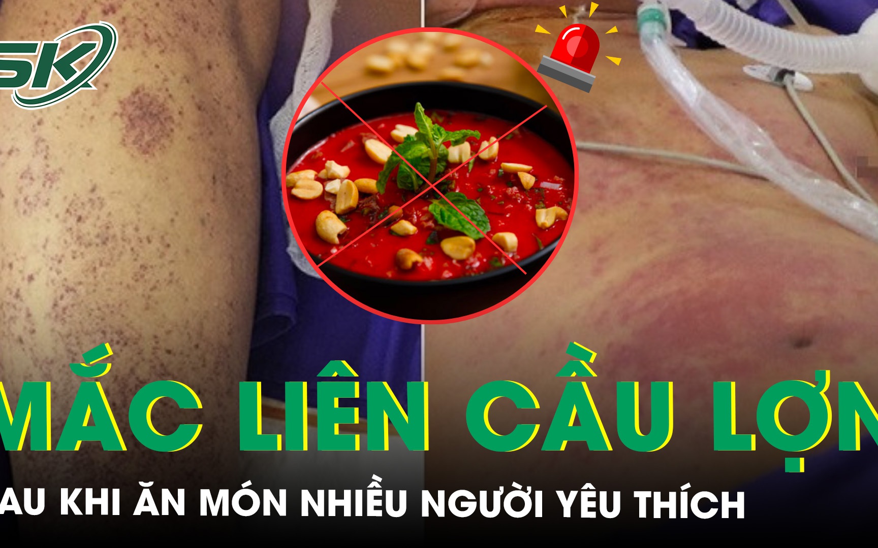 Mắc liên cầu lợn sau khi ăn món nhiều người yêu thích