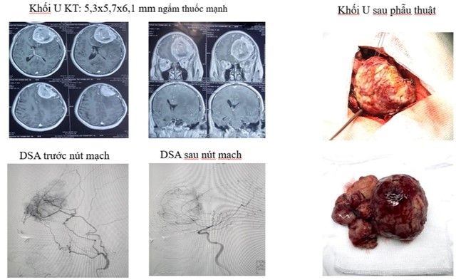 Bệnh viện Hữu nghị Đa khoa Nghệ An điều trị thành công 2 bệnh nhân có khối u não lớn, phức tạp- Ảnh 3.