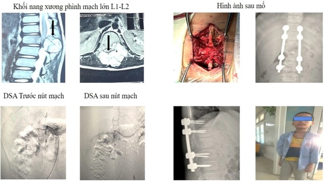 Bệnh viện Hữu nghị Đa khoa Nghệ An điều trị thành công 2 bệnh nhân có khối u não lớn, phức tạp- Ảnh 4.