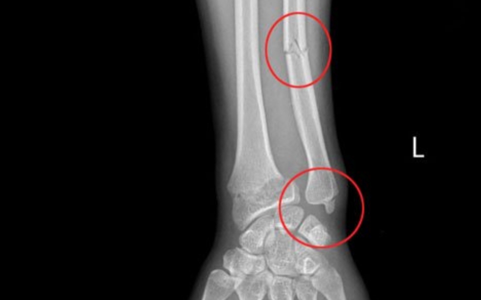 Gãy cổ xương bàn tay số V khi chơi thể thao, làm thế nào để nhận biết?- Ảnh 3.