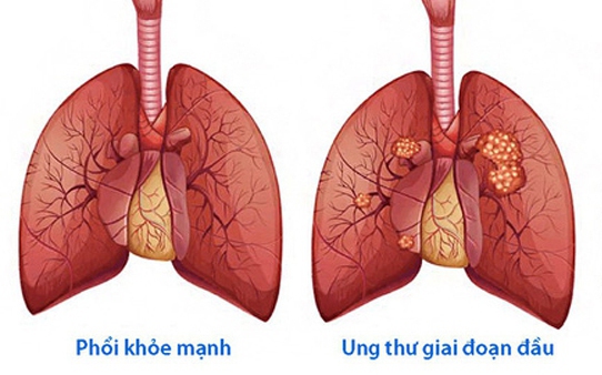 Cách tập luyện ở người mắc bệnh ung thư phổi