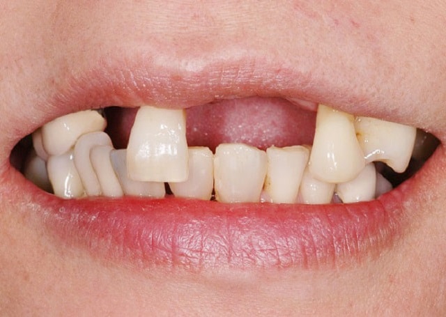 Rụng răng ở người già có phòng ngừa được không?- Ảnh 1.