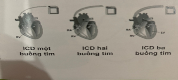 Máy khử rung tim và những điều cần biết - Ảnh 3.