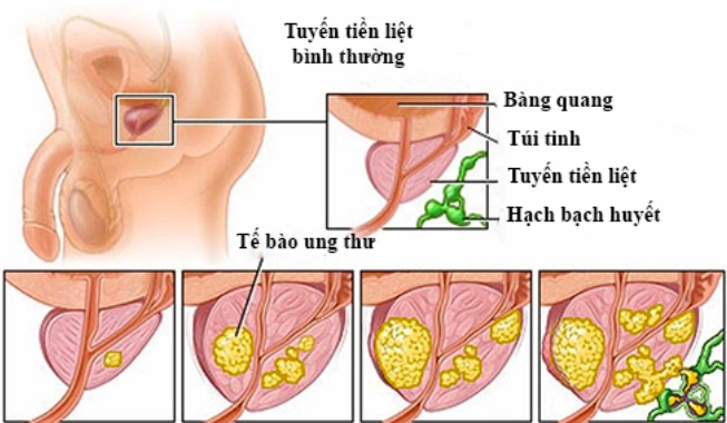 Bệnh ung thư tuyến tiền liệt cựu Tổng thống Mỹ Joe Biden mắc có nguy hiểm không?- Ảnh 1. Bệnh ung thư tuyến tiền liệt cựu Tổng thống Mỹ Joe Biden mắc có nguy hiểm không?- Ảnh 1.