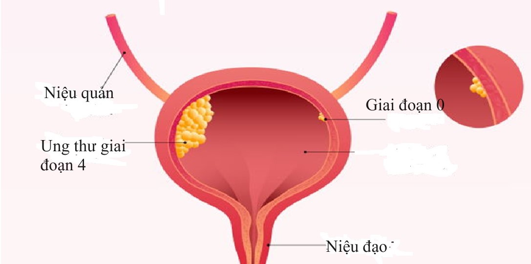 Điều trị ung thư bàng quang- Ảnh 2.