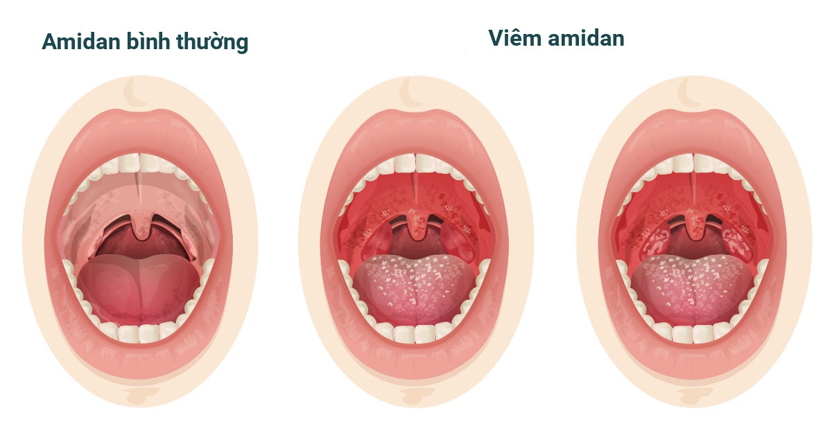 9 câu hỏi thường gặp liên quan đến bệnh viêm amidan- Ảnh 1.