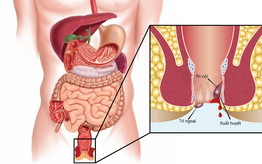 Bệnh trĩ nội hay trĩ ngoại nguy hiểm?