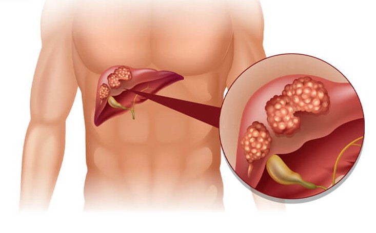 Ung thư gan có chữa khỏi được không?- Ảnh 4.