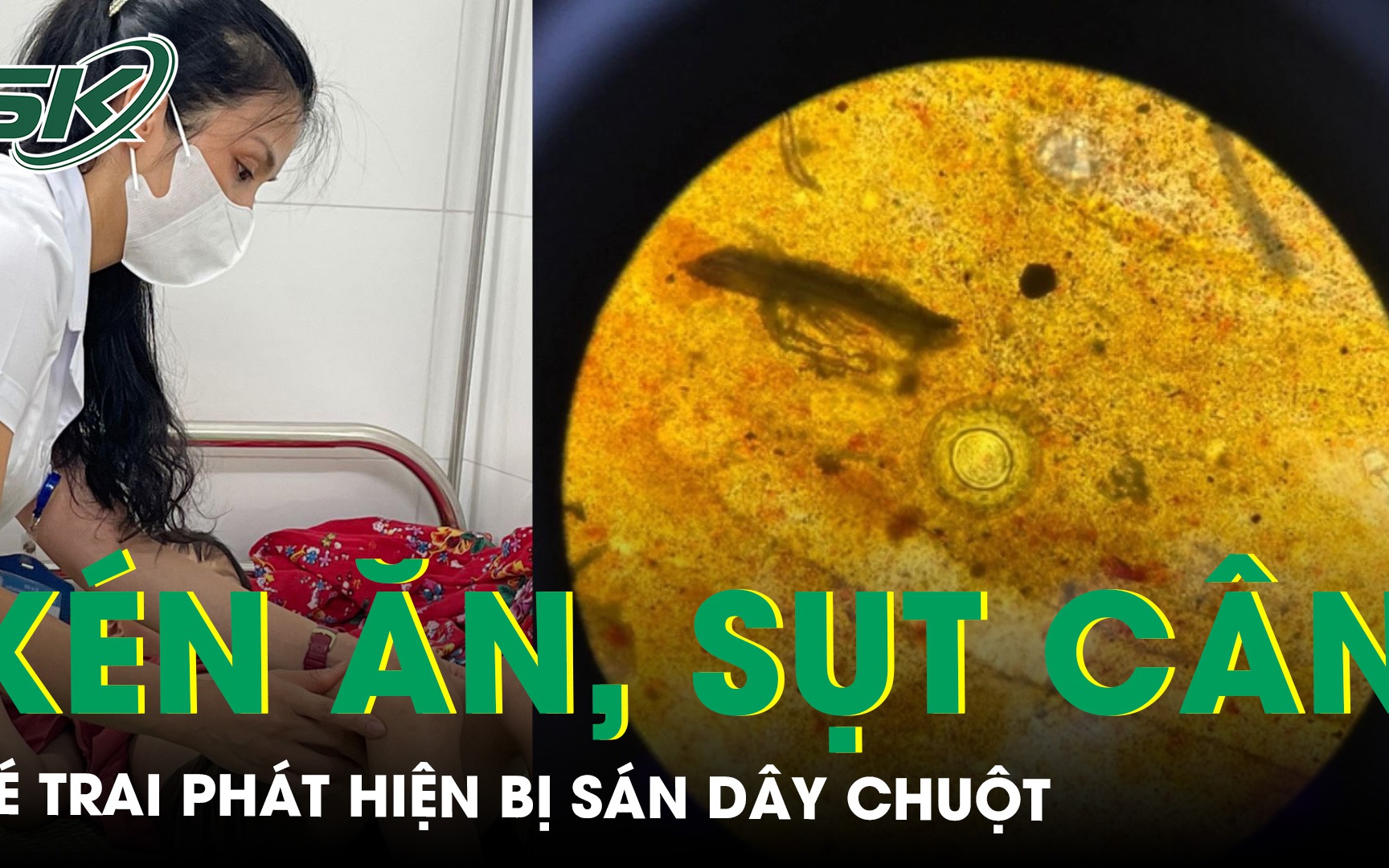 Kém ăn, sụt cân, bé trai 7 tuổi phát hiện bị sán dây chuột