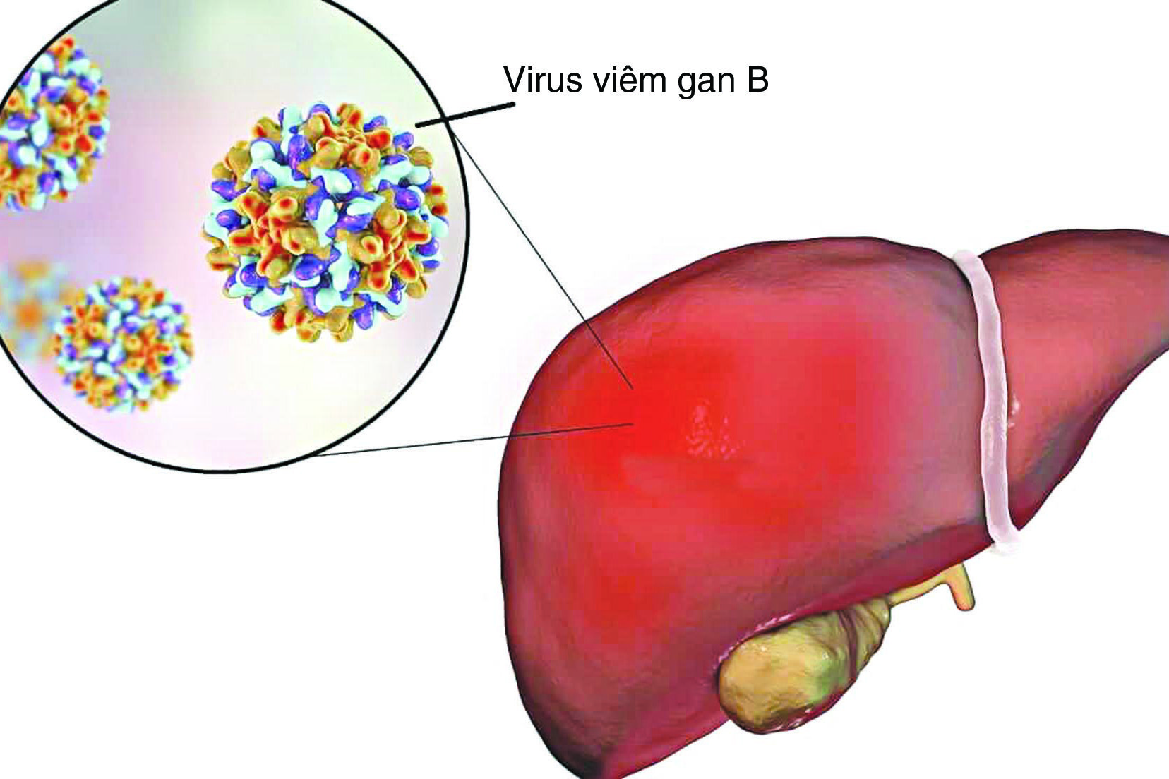 Viêm gan B sau bao lâu dẫn đến ung thư gan?- Ảnh 1.