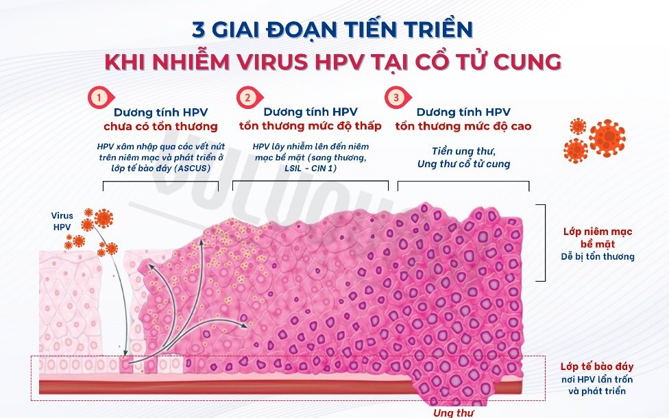 Nhiễm HPV ở cổ tử cung: cách nào giúp cơ thể đẩy nhanh khả năng tự đào thải HPV?