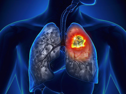 Phát hiện sớm ung thư phổi bằng cách nào?