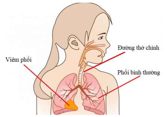 3 bệnh lý hô hấp dễ gặp trong mùa mưa và cách phòng- Ảnh 2.