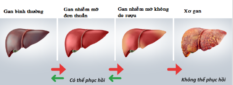 8 cách tự nhiên ngăn ngừa gan nhiễm mỡ- Ảnh 2.