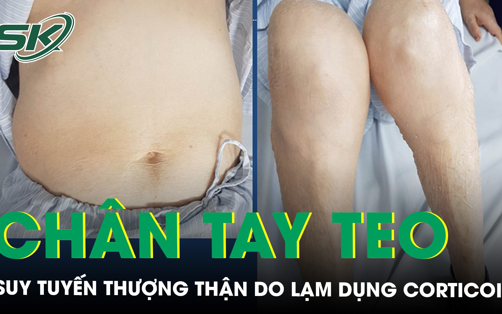 2 mẹ con mặt tròn, chân tay teo, suy tuyến thượng thận do lạm dụng thuốc corticoid