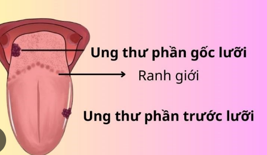 Người bệnh ung thư lưỡi nên tập luyện như thế nào?- Ảnh 1.