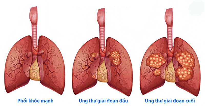 NHỮNG DẤU HIỆU CẢNH BÁO BỆNH UNG THƯ PHỔI BẠN CẦN LƯU Ý