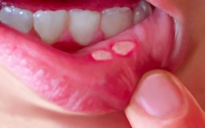 6 cách chăm sóc trẻ khi bị viêm loét miệng