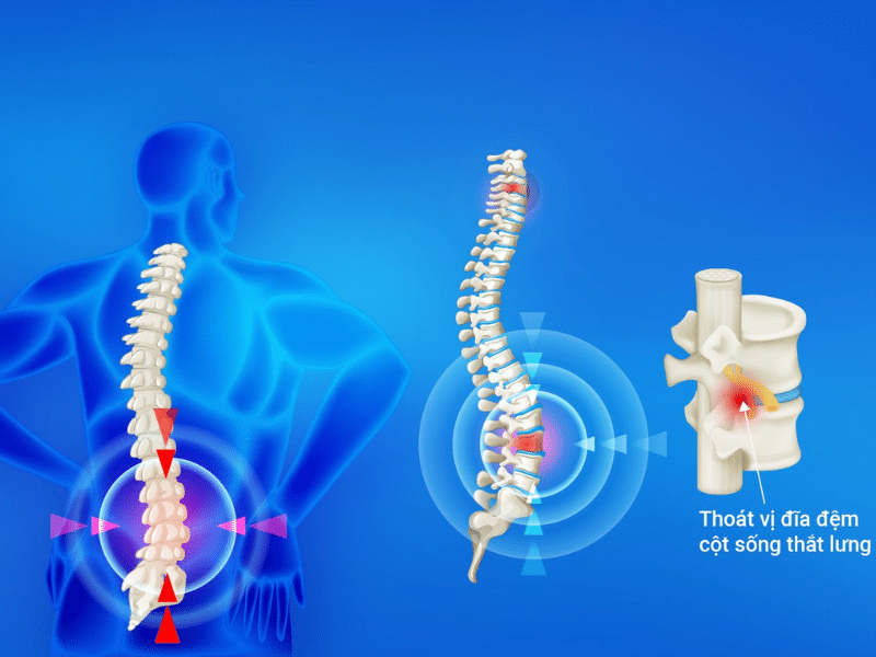 Câu hỏi thường gặp liên quan đến thoát vị đĩa đệm- Ảnh 2.