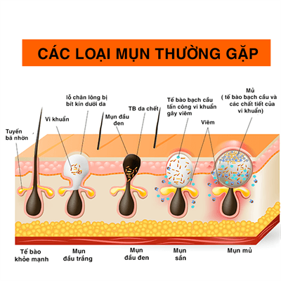 Vì sao mụn trứng cá dễ tái phát và viêm nhiễm?- Ảnh 3.