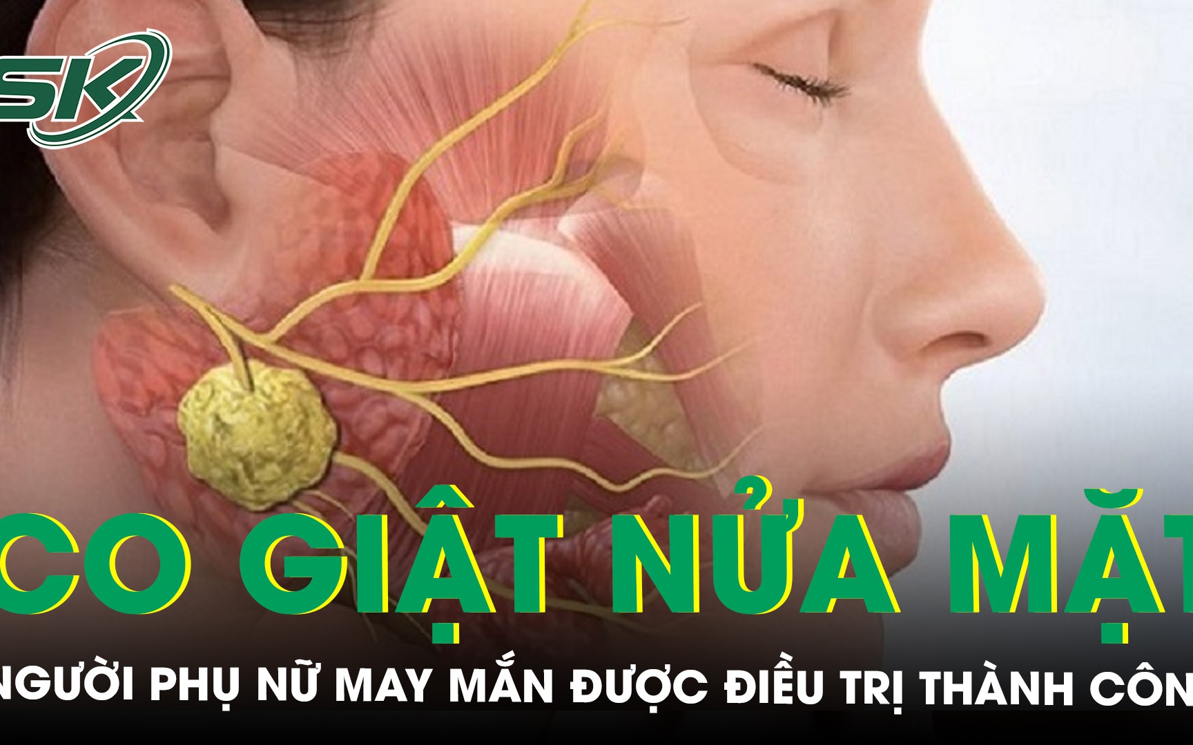 Người phụ nữ mắc chứng co giật nửa mặt suốt 25 năm may mắn được điều trị thành công