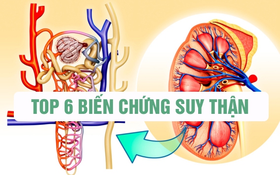 6 biến chứng suy thận và cách hỗ trợ phòng ngừa hiệu quả