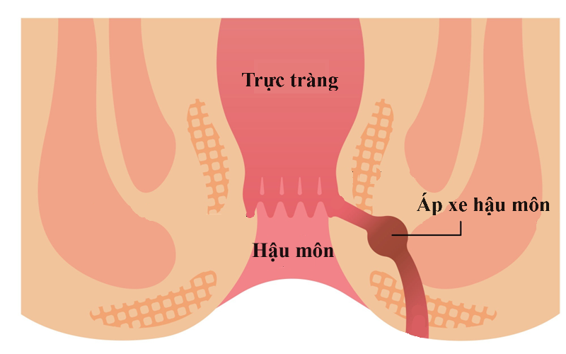 Điều trị áp xe hậu môn