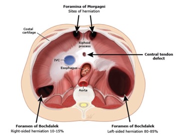 Câu hỏi thường gặp liên quan đến bệnh thoát vị hoành ở trẻ em- Ảnh 1.