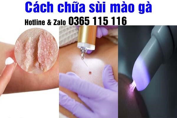 Phương pháp điều trị sùi mào gà hiệu quả tốt an toàn- Ảnh 1.