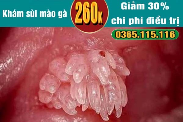 Phương pháp điều trị sùi mào gà hiệu quả tốt an toàn- Ảnh 2.