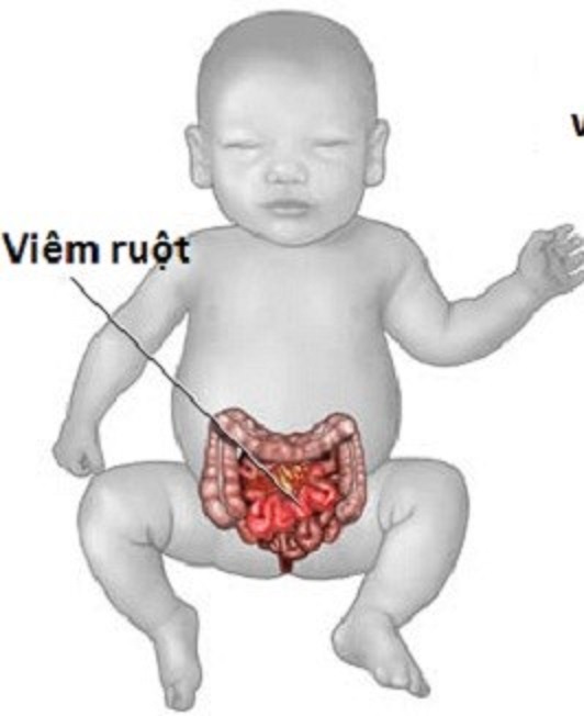 Câu hỏi thường gặp liên quan bệnh viêm ruột do virus- Ảnh 1.