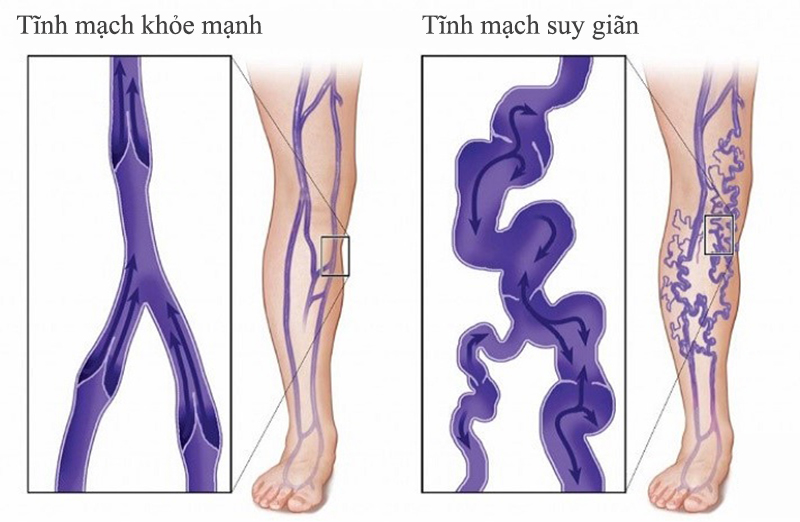 9 cách phòng suy tĩnh mạch chân cần biết