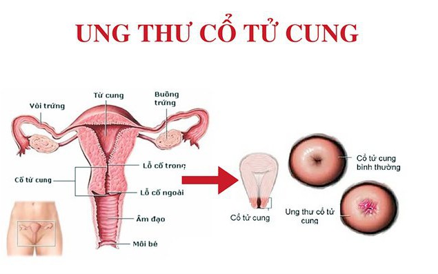 Nhiễm HPV có gây ung thư cổ tử cung?