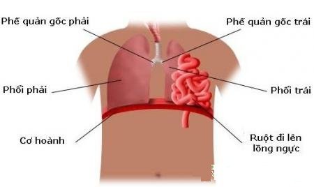 Thuốc điều trị bệnh thoát vị hoành ở trẻ em- Ảnh 1.