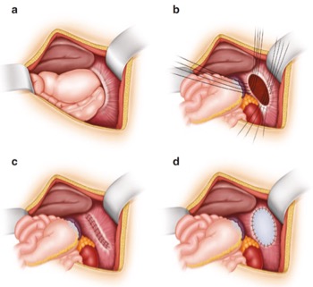 Thoát vị hoành ở trẻ em: Nguyên nhân, triệu chứng, chẩn đoán và điều trị- Ảnh 1.