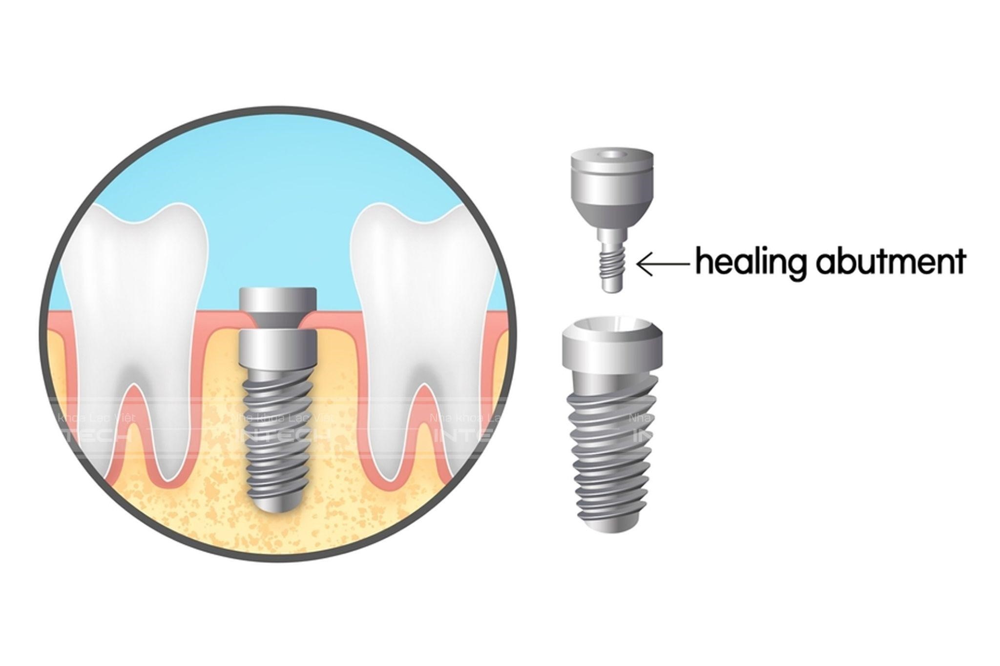 Trồng răng implant công nghệ mới: Tại sao phải sử dụng trụ lành thương giải  phẫu cá nhân hóa?