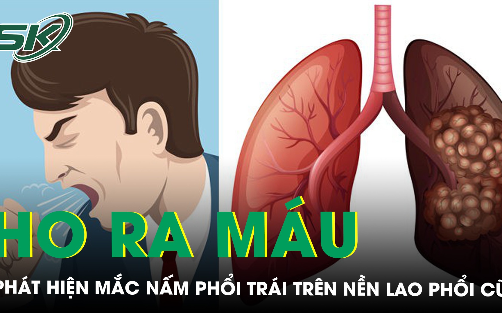 Thường xuyên ho ra máu bệnh nhân u nấm phổi bên trái trên nền lao phổi cũ