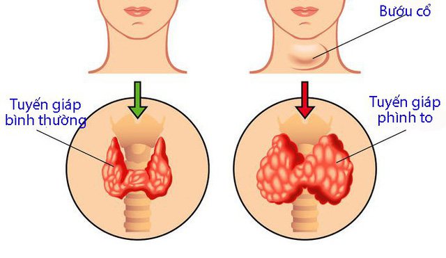 Bướu Cổ Có Mấy Loại? Tìm Hiểu Chi Tiết Về Các Dạng Bướu Cổ Phổ Biến