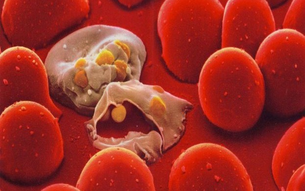 Tan máu bẩm sinh (Thalassemia): Nguyên nhân, triệu chứng và cách điều trị bệnh