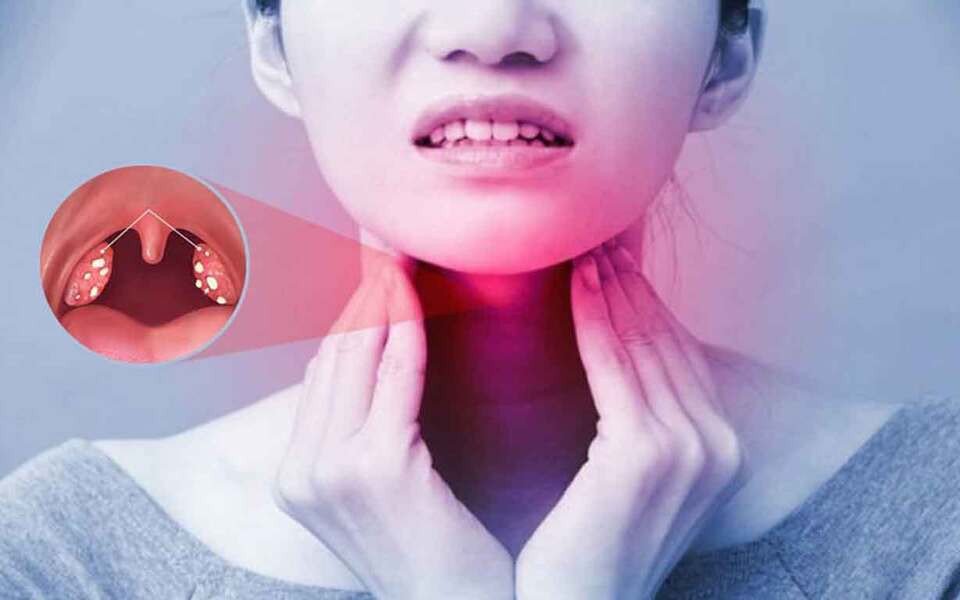 Dấu hiệu của viêm amidan hốc mủ