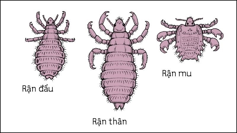 Các biện pháp điều trị chấy rận- Ảnh 1.