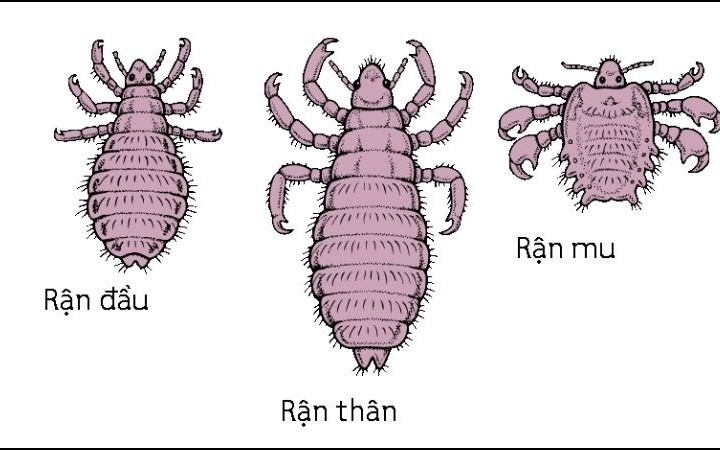 Các biện pháp điều trị chấy rận