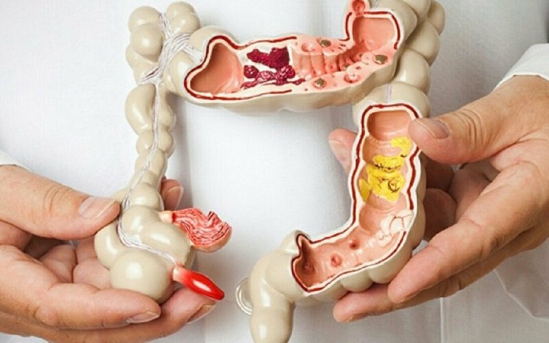 Các phương pháp điều trị bệnh Crohn