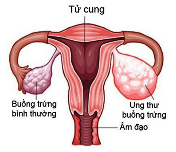 Bạn đã hiểu rõ về ung thư buồng trứng?