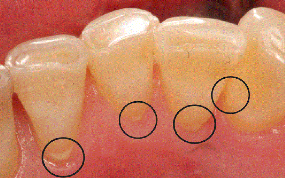 7 biện pháp loại bỏ cao răng tại nhà